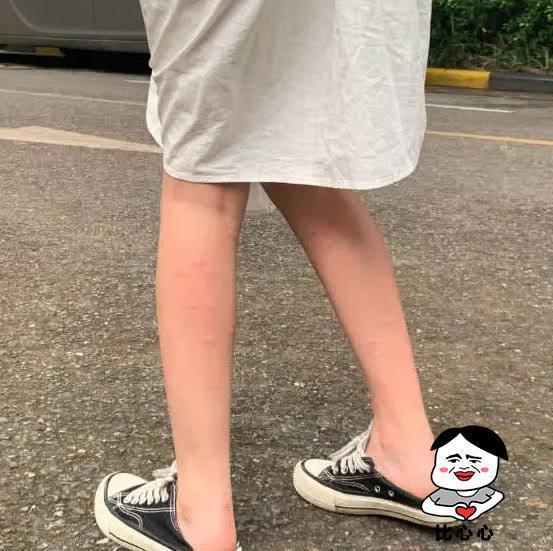 允恩晒与“新男友”合照,可她的腿却成亮点,现任没照顾好她吗?