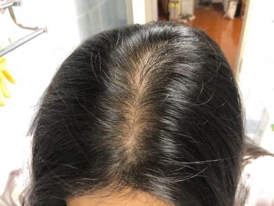 ​为什么很多人知道米诺地尔，还是不敢用？用了是不是就不能停