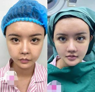 ​网红韩安冉再次整容！嘴唇肿胀刀痕明显，晒素颜对比图太吓人