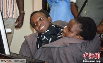 ​21岁世界知名连体婴姐妹去世：去年被大学录取