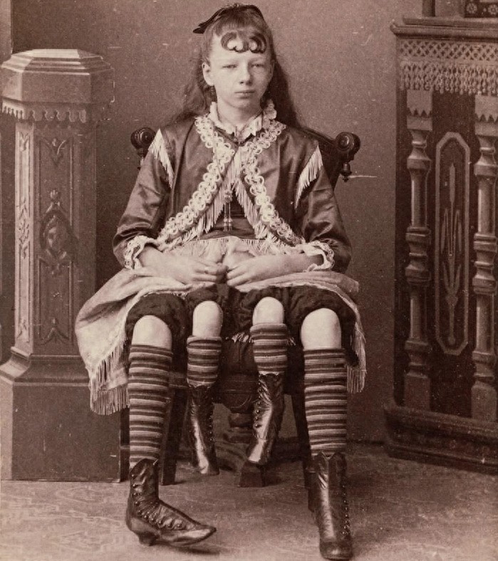 图揭19世纪“怪胎” 身体畸形诡异神秘