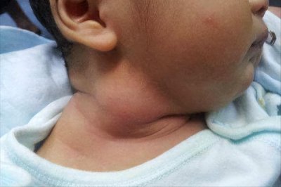 ​揭秘：宝宝“歪脖子”的4个原因，不只是斜颈！