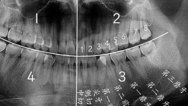 生活拔智齿后悔死了，拔智齿有后遗症吗  2
